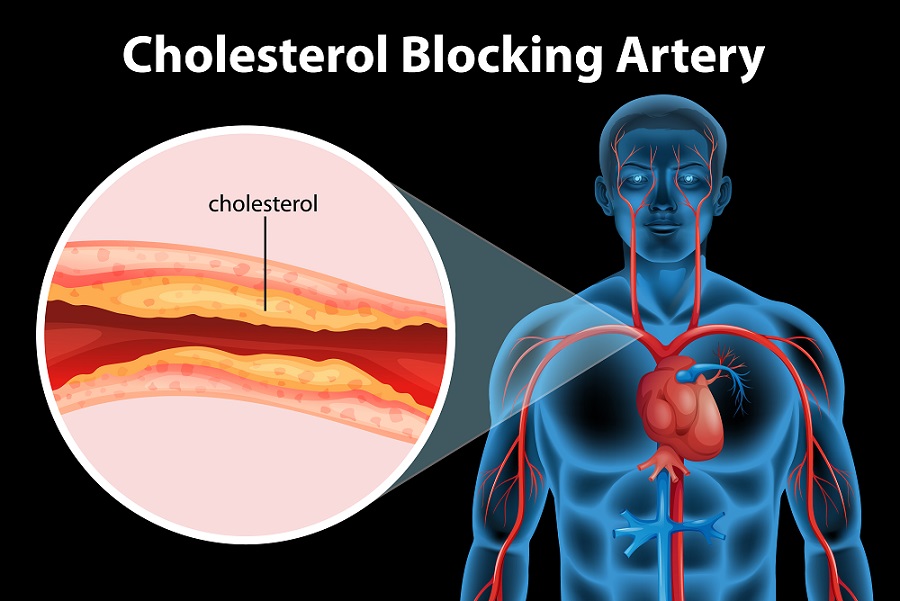 High Cholesterol Symptoms Diagnosis And Prevention Grunwald Health India 0027